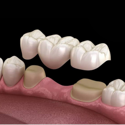 Best Dentist in Aurangabad-Crown & Bridges