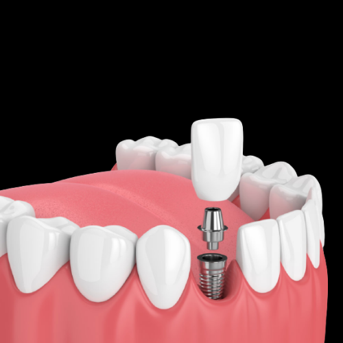 Best Dentist in Aurangabad-Dental Implant