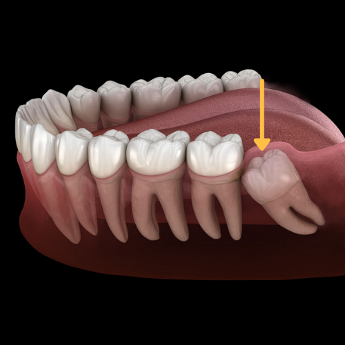 Best Dentist in Aurangabad-Wisdom Tooth Removal