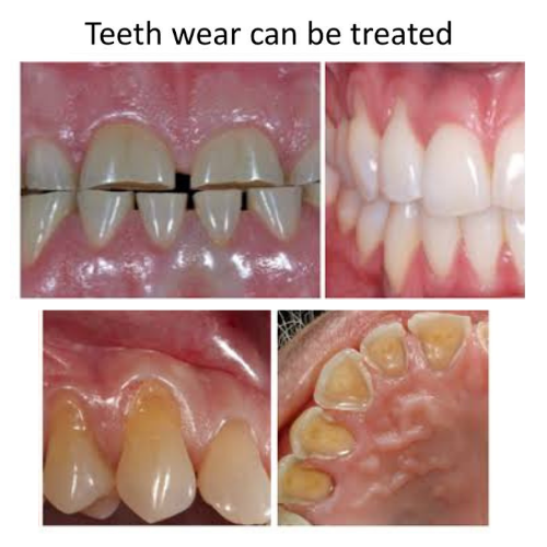 Are you suffering from teeth wear?