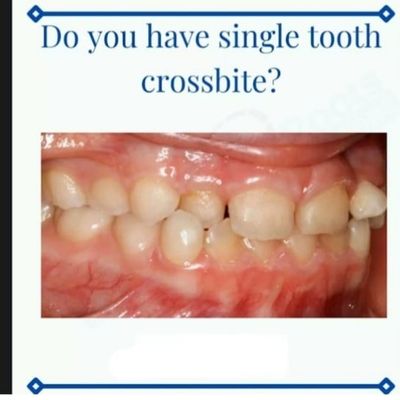 Do you have single tooth crossbite