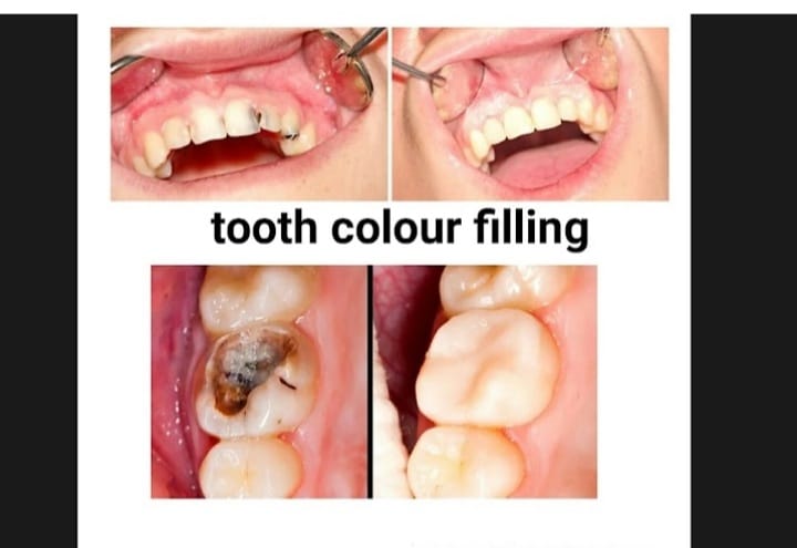 Tooth colour filling treatment