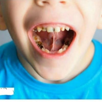 Multiple cavities at early age