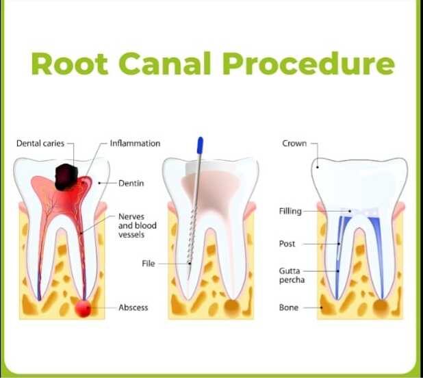 Root Canal Procedure