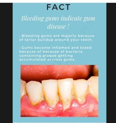 FACT Bleeding gums indicate gum<br>disease!