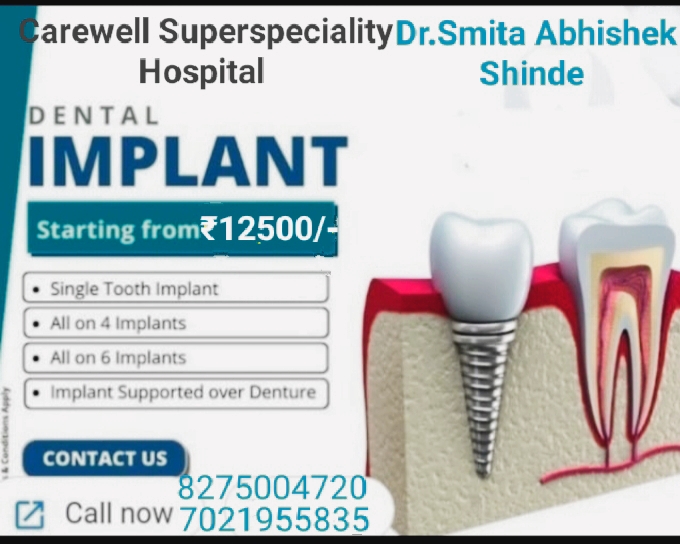 Dental implant