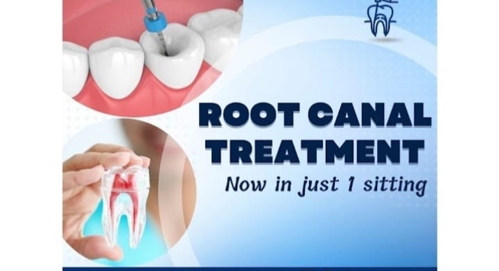 Root Canal Treatment