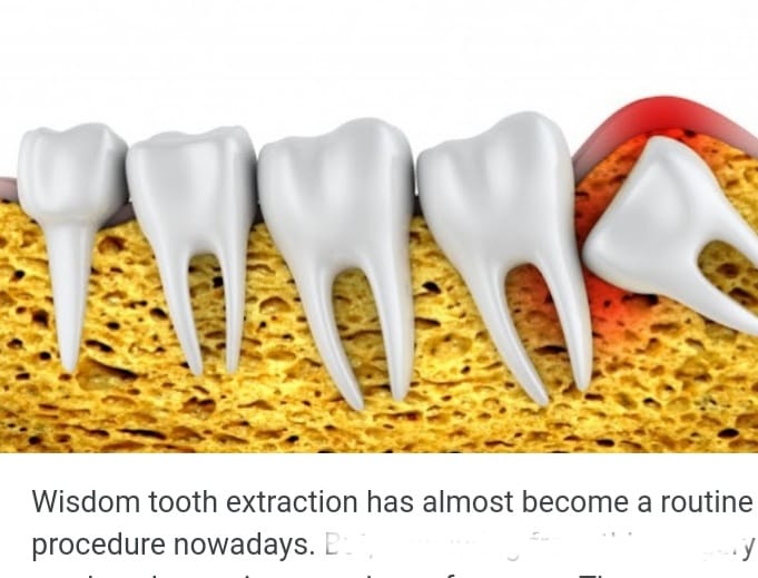 Widsome tooth extraction